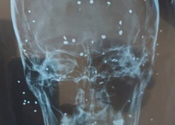An X-ray image provided by an Iranian doctor of a skull showing pellets from a shotgun round.