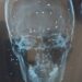 An X-ray image provided by an Iranian doctor of a skull showing pellets from a shotgun round.