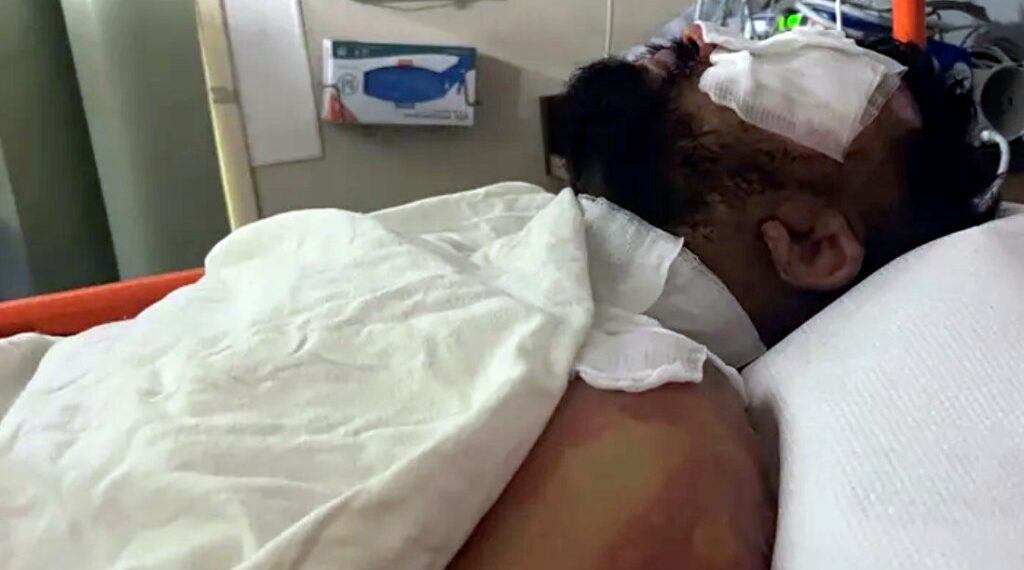 The clerk will need several surgeries as a result of his burns he suffered at the hands of Burton's attack.